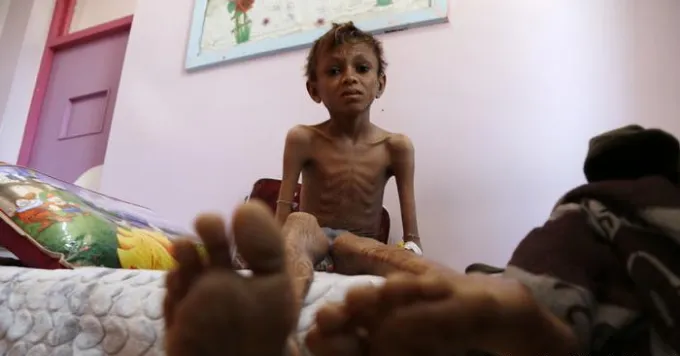 Image d'un enfant en sous alimentation, très maigre avec un visage plein de détresse et de fatigue.